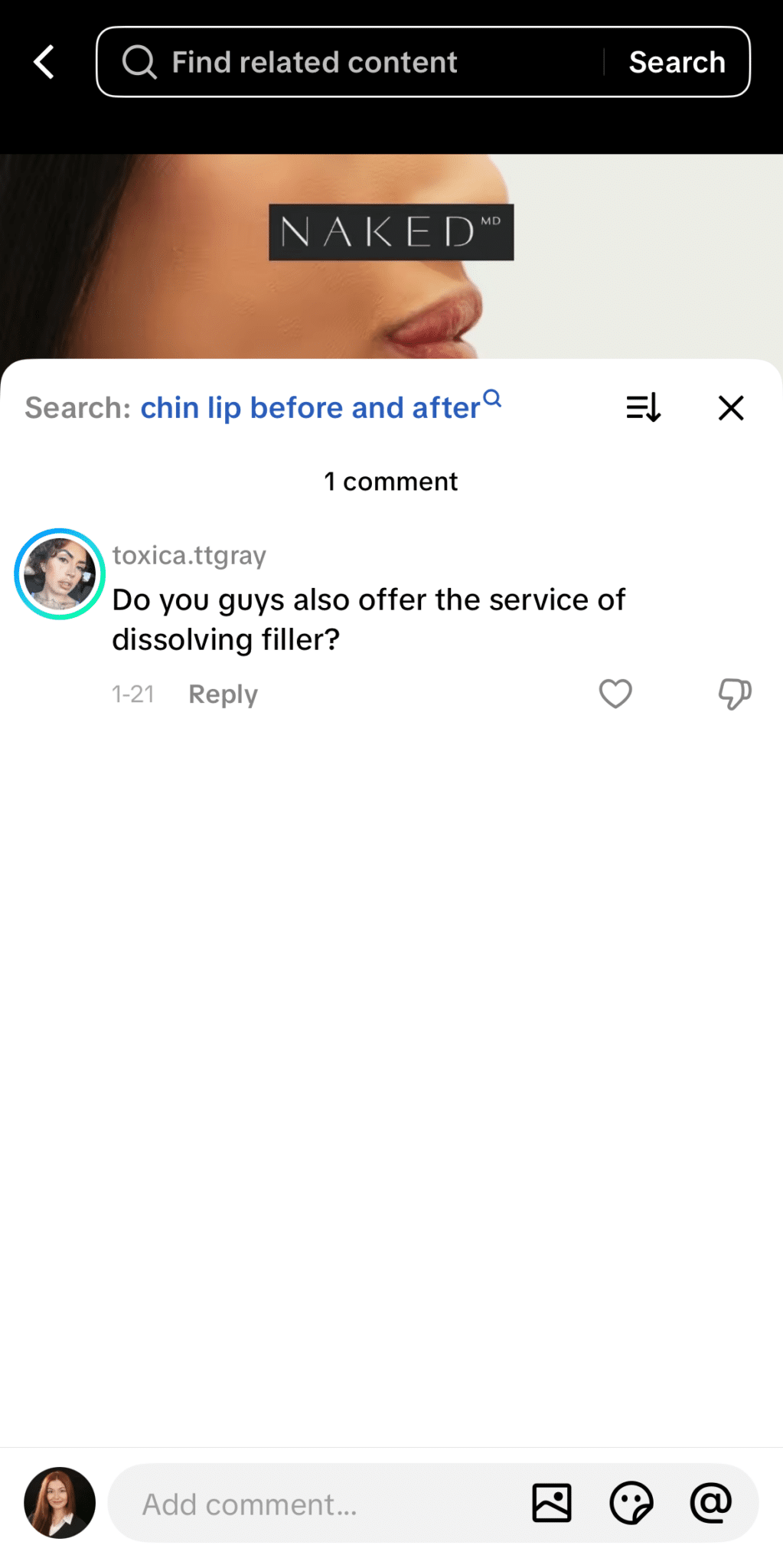 ```json
{
"alt": "Close-up of a woman's chin with a comment on dissolving filler services.",
"caption": "Inquiring minds want to know: Does this beauty service offer filler dissolving treatments?",
"description": "This image features a woman's chin in close-up, with a focus on a comment asking about filler dissolving services. The branding 'NAKED MD' is displayed prominently. The search query 'chin lip before and after' suggests a focus on cosmetic procedures. The comment has received one reply, indicating an interactive discussion. Keywords include beauty, cosmetic procedure, and filler treatment."
}
```